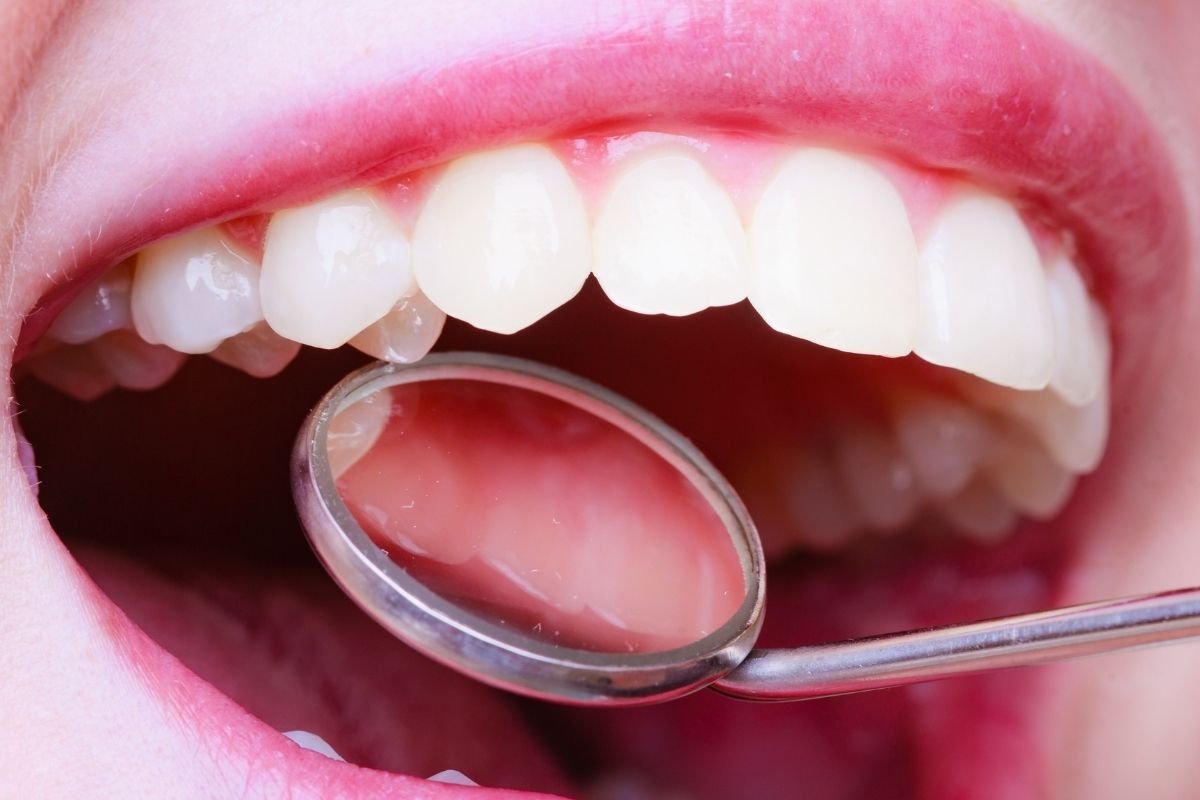 Épulis: todo lo que debes saber