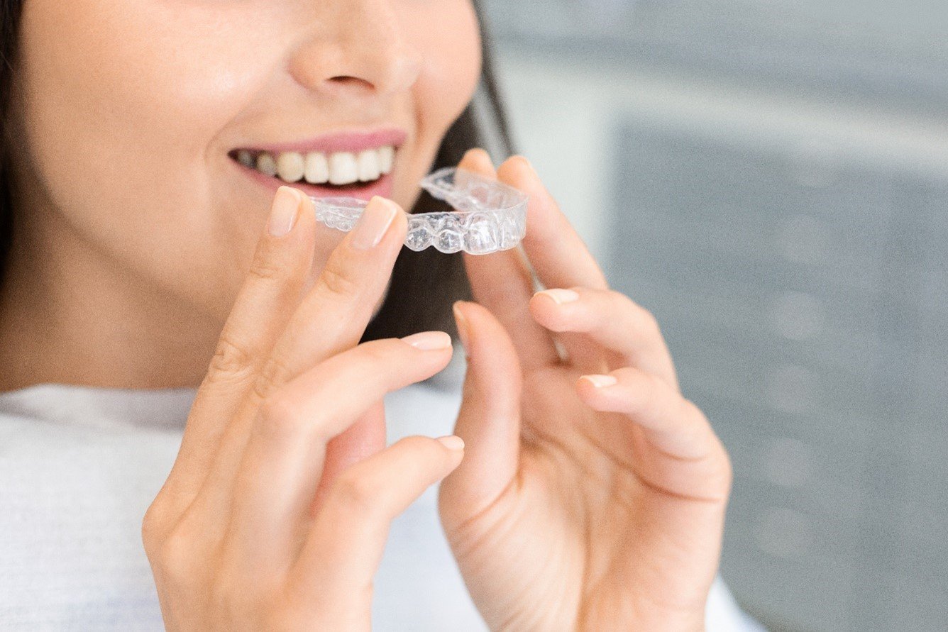 Ortodoncia invisible Invisalign: ¿Qué es y cuáles son sus beneficios?